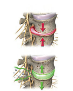 Spinal Decompression with Dr. Grant