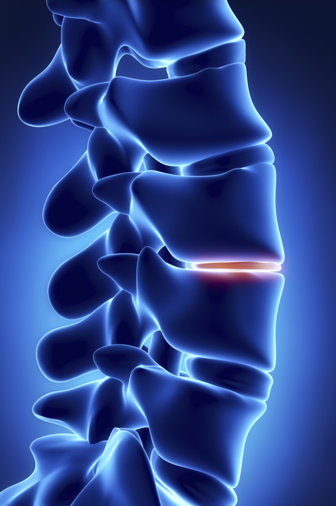 Degenerative Disc Disease With Dr. Grant in Salt Lake City