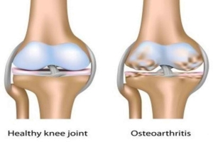 osteoarthritis knee joint drawing Dr. Grant