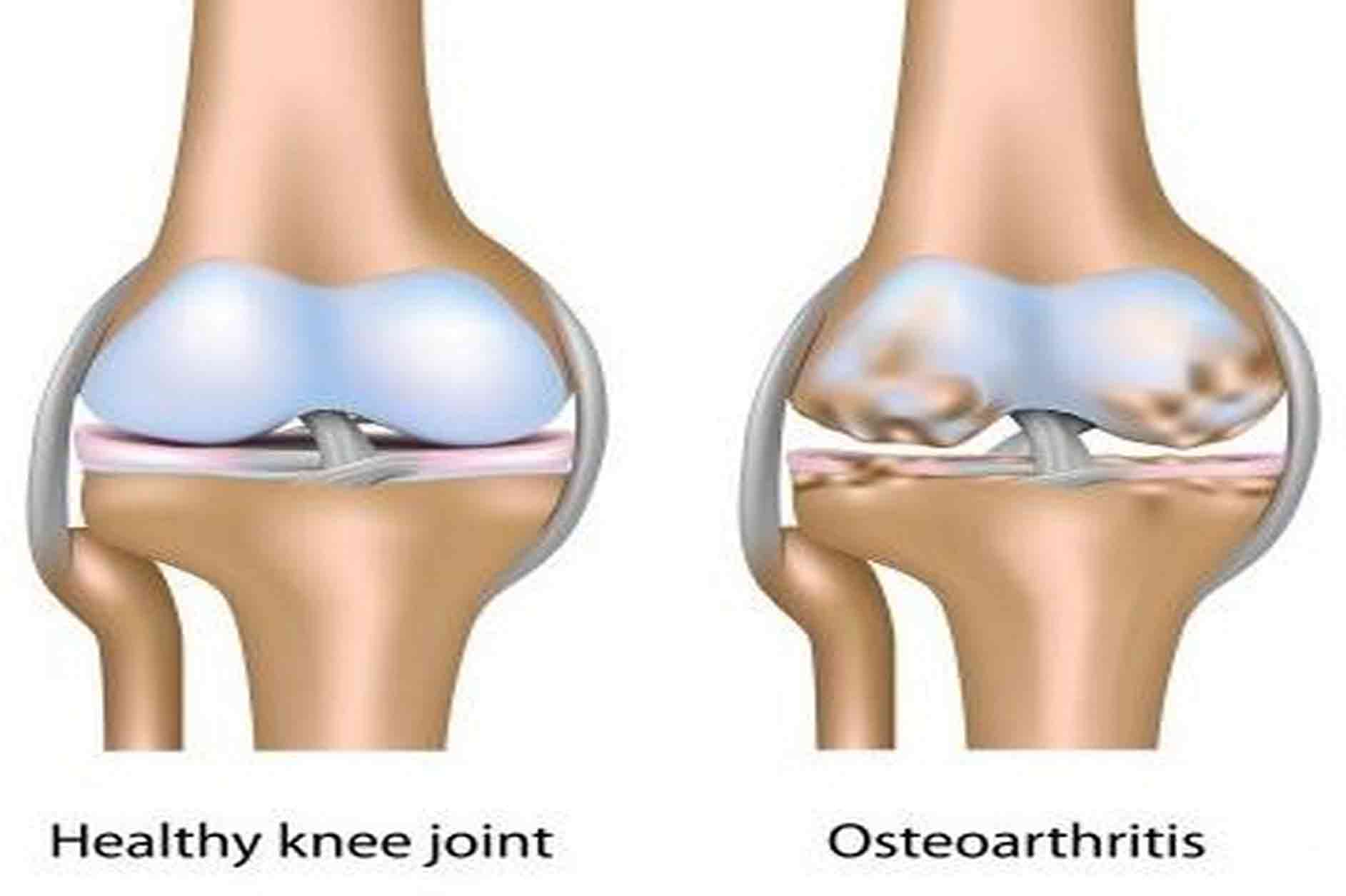 Остеоартроз это. Деформирующий остеоартроз (доа). Гонартроз- деформирующий артроз коленного сустава. Хондромаляция медиального мыщелка.