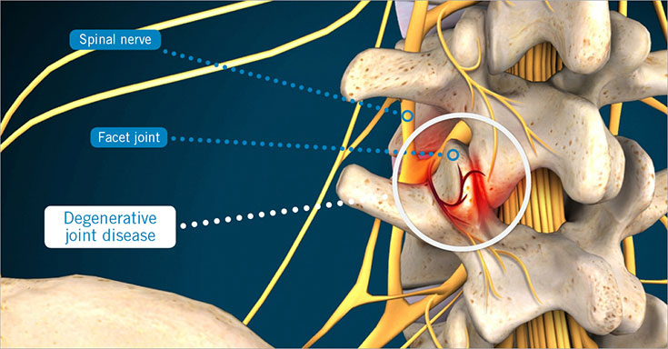 5 Things You Should Know About Degenerative Joint Disease